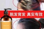 用什么洗头治疗脱发（用什么洗头防脱发  用醋洗头 防脱发 ）