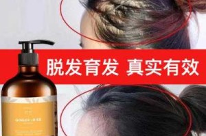 用什么洗头治疗脱发（用什么洗头防脱发  用醋洗头 防脱发 ）