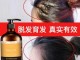 用什么洗头治疗脱发（用什么洗头防脱发  用醋洗头 防脱发 ）