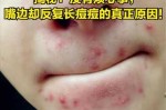 嘴角边有粉刺怎么办,嘴角长粉刺是什么原因啊