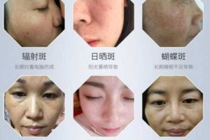 雀斑怎么去除最有效祛斑用什么方法最好,怎么可以祛雀斑呢