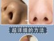 黑头怎么祛（黑头怎么祛除最有效）