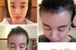 发际高怎么办（发际线好高怎么办）