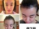 发际高怎么办（发际线好高怎么办）