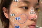 脸上长青春痘怎么去除（脸上长青春痘怎么去除小妙招）