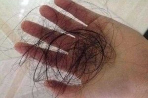 高中生脱发严重怎么办（高中生脱发严重怎么办女）