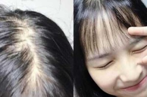 总掉头发怎么办,女生头发掉的多怎么办
