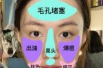 脸上毛细孔粗大该怎么办,脸毛细孔粗大解决方法
