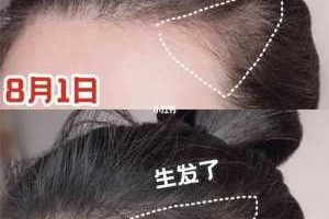 两鬓脱发怎么办（两鬓脱发怎么办女性）