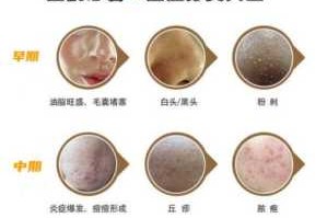 痘痘的什么（痘痘的什么）