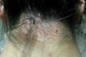 染头发头皮发痒有什么事吗,头发老是痒是怎么回事呀