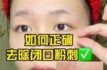 怎么去掉粉刺（去除粉刺闭口的方法）