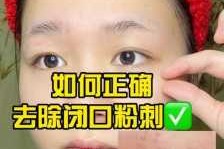 怎么去掉粉刺（去除粉刺闭口的方法）
