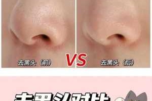 鼻子上的黑头怎么去除简单方法（鼻子有黑头怎么去除）