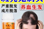 什么治疗头发（什么治疗头发稀少）