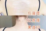 后背上的痘痘怎么去除（背部痘痘如何消除）