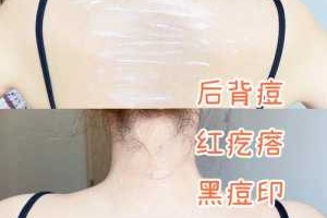 后背上的痘痘怎么去除（背部痘痘如何消除）