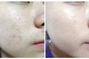 黑头毛孔粗大怎么改善（脸上有黑头毛孔粗大怎么改善）