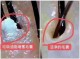 头皮毛囊堵塞怎么疏通（头皮毛囊堵塞怎么清洗）