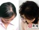 老掉头发是怎么回事,经常脱头发怎么办女性