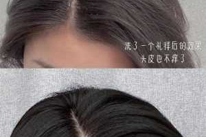 为什么留长发头屑会变多,头发头皮多怎么办怎么才能去掉