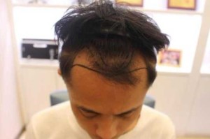 鬓角两边秃怎么拯救,秃鬓角怎么能长头发呢