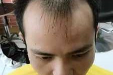 头顶有点秃剪什么发型,头顶有点脱发怎么办啊