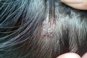 头上长一块一块头皮屑是什么原因,突然头上很多头皮屑是怎么回事
