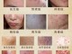脸上粉刺多怎么办（脸上长了很多痘痘是怎么回事？应该怎么去除）