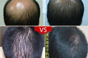 怎么治脱头发（怎么治脱头发最好最快）