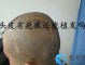 植发有什么副作用（植发有什么副作用和危害）