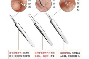 怎么用暗疮针（怎么用暗疮针挤痘痘）