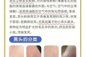 去黑头怎么去（怎么去黑头的方法）