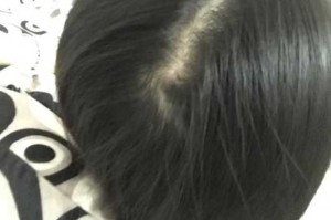 后脑头发稀少怎么办（为什么后脑勺头发会越来越少）