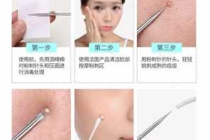 粉刺针怎么用图解（粉刺针怎么用图解黑头）
