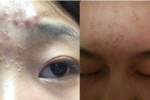 长痘痘了怎么消除,眉毛上面长痘怎么消除