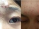 长痘痘了怎么消除,眉毛上面长痘怎么消除