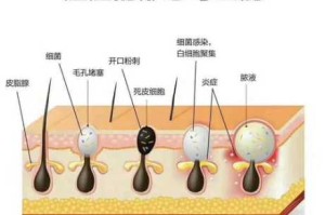 粉刺是怎么形成的图片（粉刺是怎么形成的图片大全）