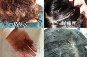 头屑多掉发是什么原因（头屑多掉发是什么原因造成的）