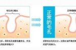 头发毛孔堵塞怎么彻底清理,脸上毛孔堵塞怎么疏通毛孔