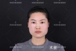 大方脸怎么改善脸型,方脸怎么整容