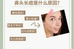怎么治鼻子上的痘痘（鼻子上的痘痘怎么去掉）