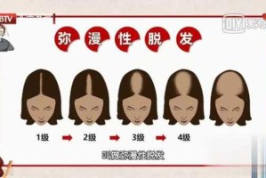 一直脱发是什么原因（一直脱发是什么原因引起的）