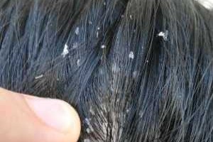 头皮屑特别多怎么回事（男士头皮屑多是什么原因）