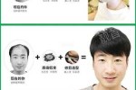 织发、种植头发、假发是一样的吗,什么地方可以种头发呢