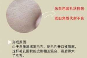 毛细孔粗大是什么原因（毛细孔粗大是什么原因造成的）