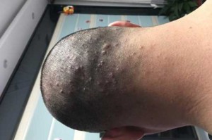 头上起痘痘怎么回事（头上起痘痘怎么回事儿）