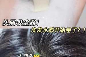 头上的头皮屑如何清理干净,冬天头发头皮屑多怎么办