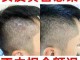 头皮屑多怎么治疗（头皮屑多怎么治疗偏方）