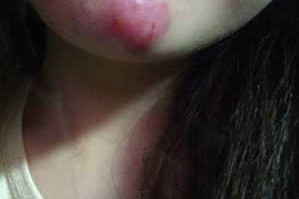 下巴起痘痘怎么办（下巴起痘痘怎么办才能消除）